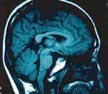 MRI of human brain, sagittal section